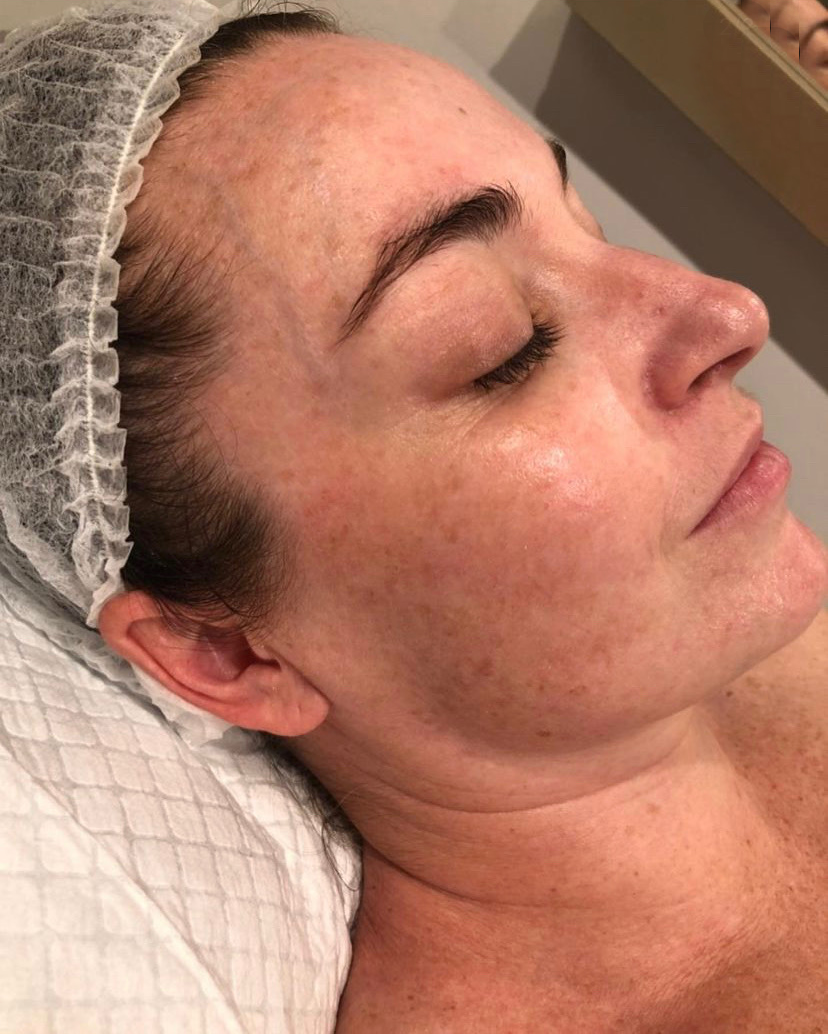 Considering a pigmentation peel? Cosmelan is the real deal