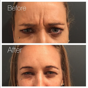 Forehead Wrinkles Before and After - Injectables