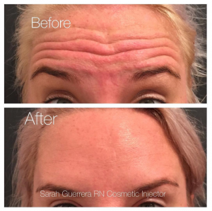 Elder Forehead Wrinkles Before and After - Injectables