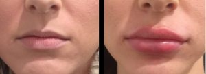 dermal lip filler injections gold coast including lip enhancement and lip augmenation
