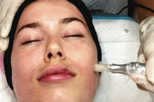Microdermabrasions Services - Injectables